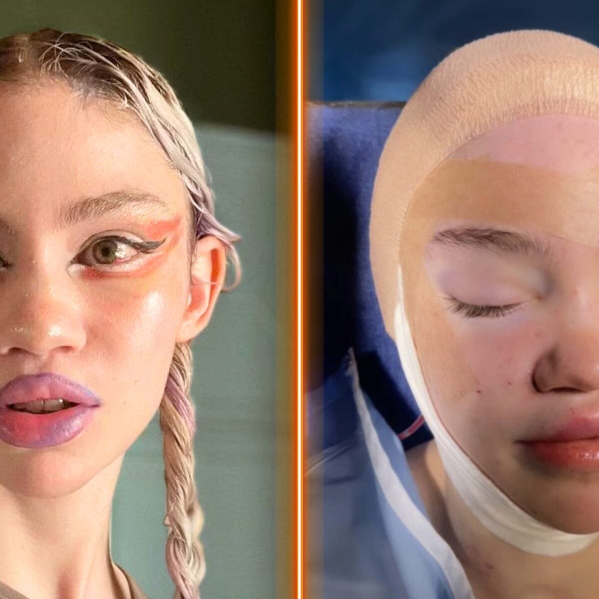 H Grimes έκανε νέα πλαστική επέμβαση: Η ριζική αλλαγή στο σώμα της, πόνεσε πολύ